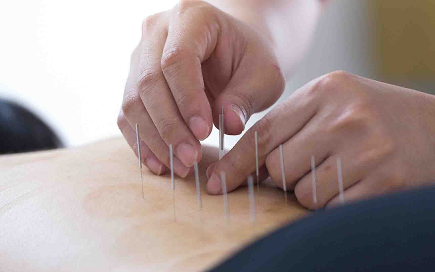 Understanding Medicare and Acupuncture | Oak Street Health